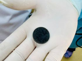 В Якутии 5-летний ребенок проглотил пятирублевую монету и проходил с ней два дня