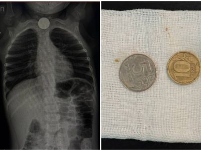 Две монеты из пищевода трехлетнего мальчика извлекли врачи в Якутске