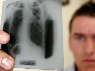 В Якутии в противотуберкулезные диспансеры принудительно отправили 16 человек