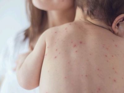 В трех российских регионах зафиксированы вспышки кори