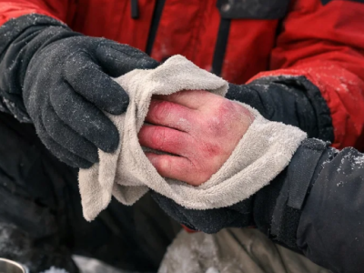 Первая помощь при обморожении: краткое практическое руководство