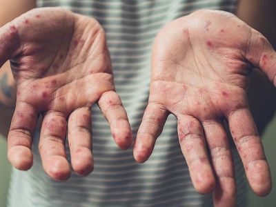 Вероятность очередной волны высока. В Якутске зафиксировано 70 заболевших корью