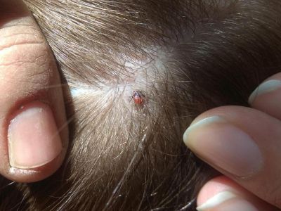 В Якутии четверо человек пострадали от укусов клещей