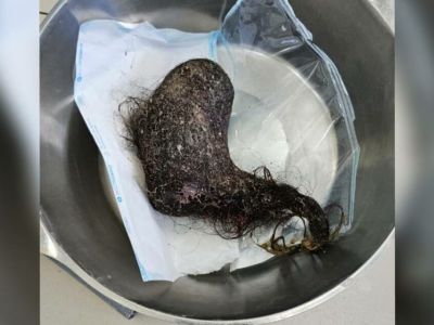 Якутские врачи удалили из желудка девушки огромный комок волос