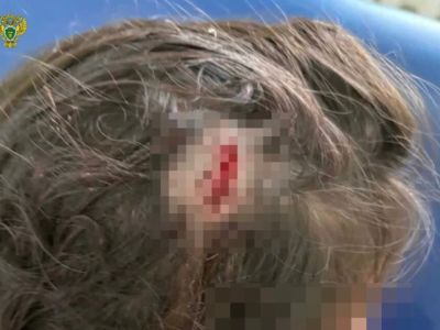 С детского сада в Якутии взыскали компенсацию за травму ребенка 