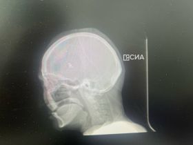 Мобильные хирурги Якутии исправили дефект черепа пенсионерке