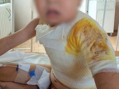 Мальчик поджег пятилетнего ребенка в Намском районе