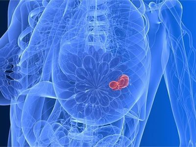 Пять мифов о раке молочной железы