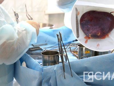 Поглотила всю селезенку: врачи в Якутии спасли 23-летнюю девушку с гигантской кистой