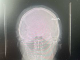 Мобильные хирурги Якутии исправили дефект черепа пенсионерке