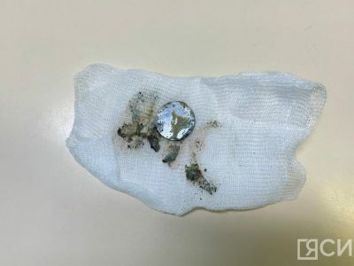 В Якутии годовалый ребенок проглотил литиевую батарейку и проходил с ней шесть дней