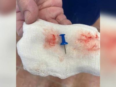 Канцелярский гвоздь извлекли врачи из легкого подростка в Якутии