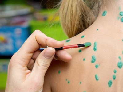 Что такое ветрянка: первые признаки, симптомы и течение болезни