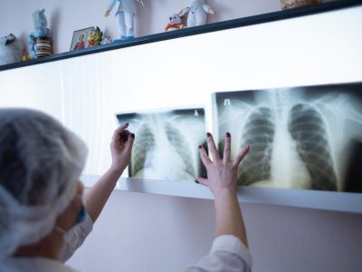 Мероприятия по борьбе с туберкулезом пройдут в Якутии в течение месяца