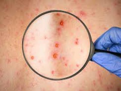 Осторожно: корь!