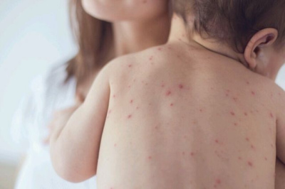 В трех российских регионах зафиксированы вспышки кори / ЯСИА   