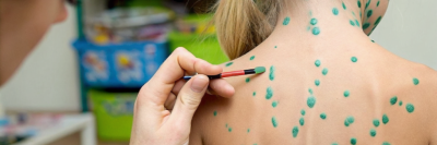 Что такое ветрянка: первые признаки, симптомы и течение болезни