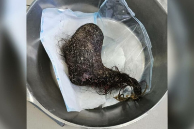 Якутские врачи удалили из желудка девушки огромный комок волос / Саина Титова   