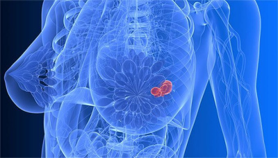 Пять мифов о раке молочной железы / ЯСИА   