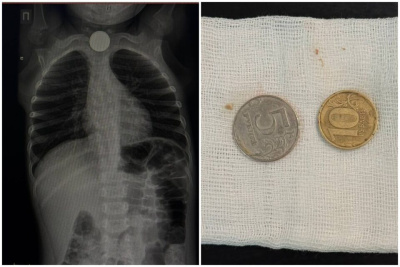 Две монеты из пищевода трехлетнего мальчика извлекли врачи в Якутске / Саина Титова Якутск Якутск Республика Саха (Якутия)