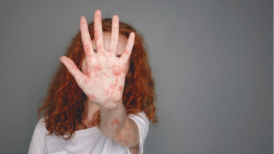 В Якутии число заболевших корью выросло до 13 человек / ЯСИА   Республика Саха (Якутия)