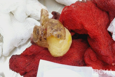 В Якутии врачи извлекли из кишечника женщины целый картофель / Саина Титова   Республика Саха (Якутия)